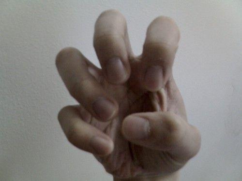 Sign 13: Unexplained Wrist Soreness (Carpal Tunnel Mimic)
