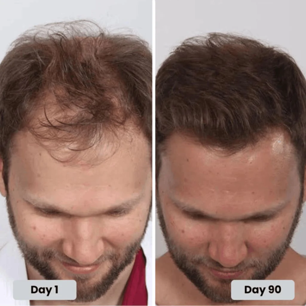 Hair regrowth, day 1 to day 90