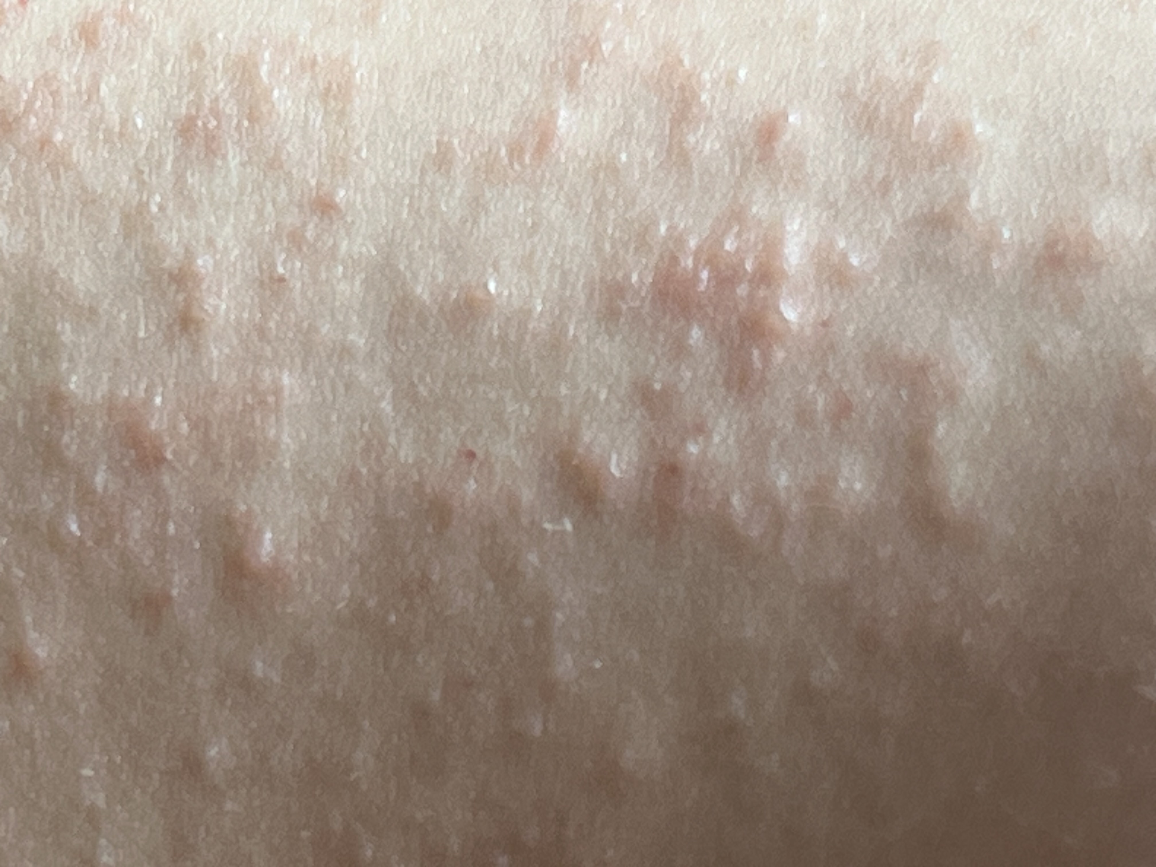 what kind of rash is this : r/AskDocs