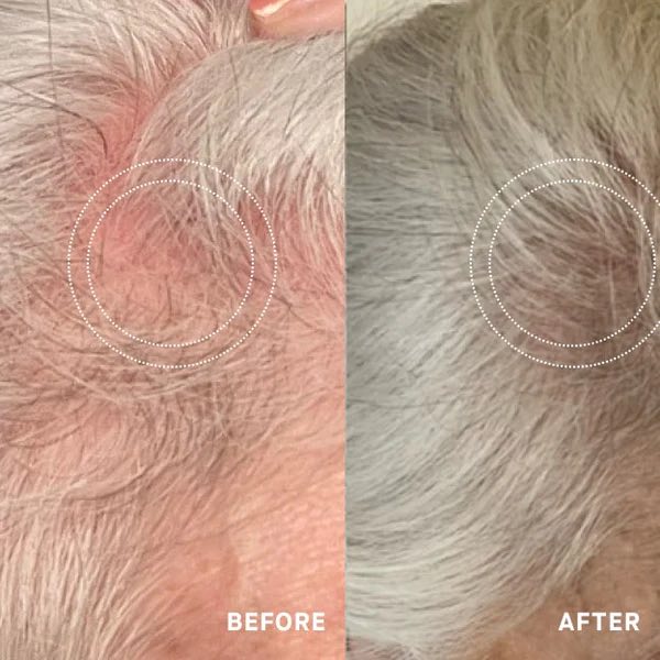 THICKR before and after — Joan R., visibly fuller hairline