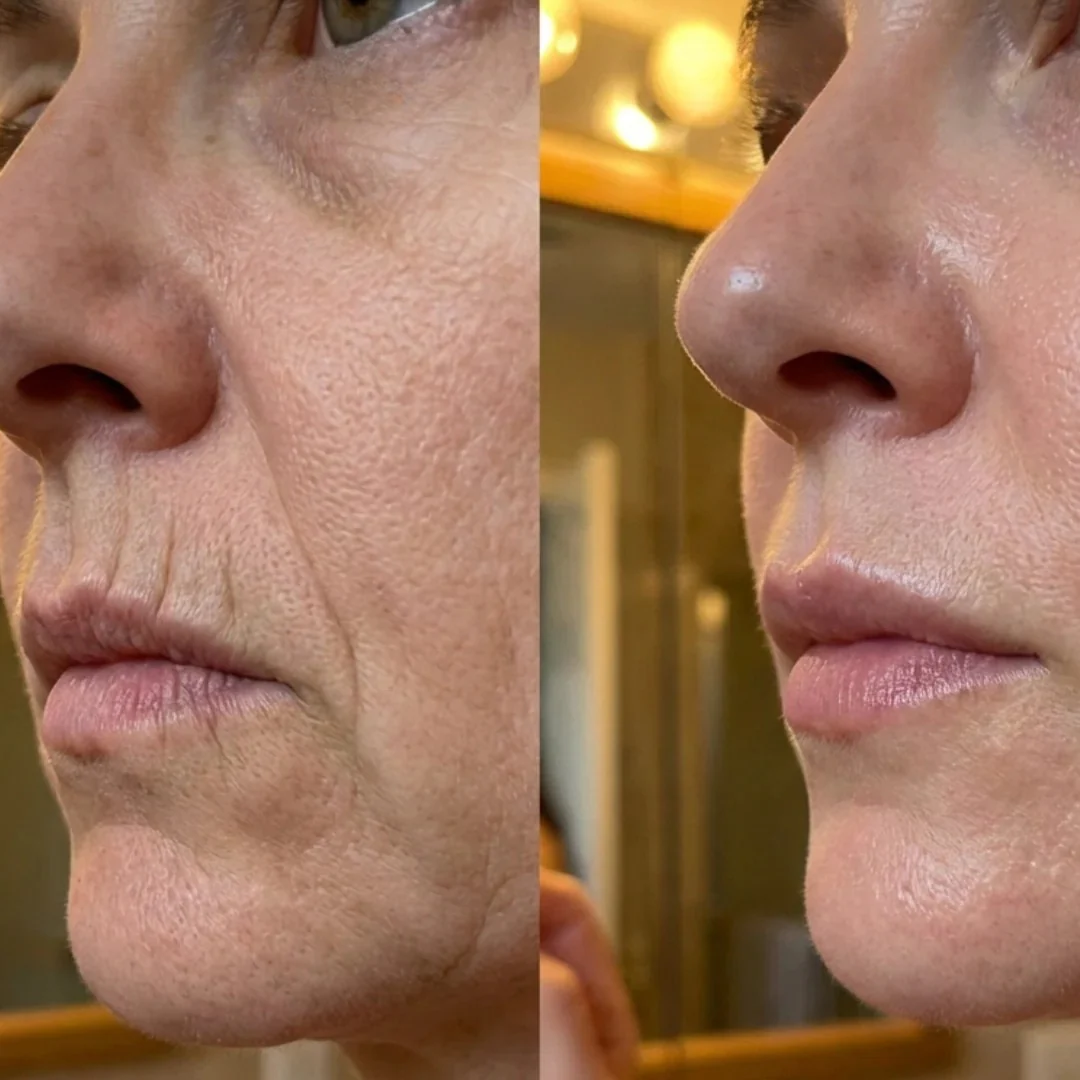 Smoother smile lines and jawline, before and after
