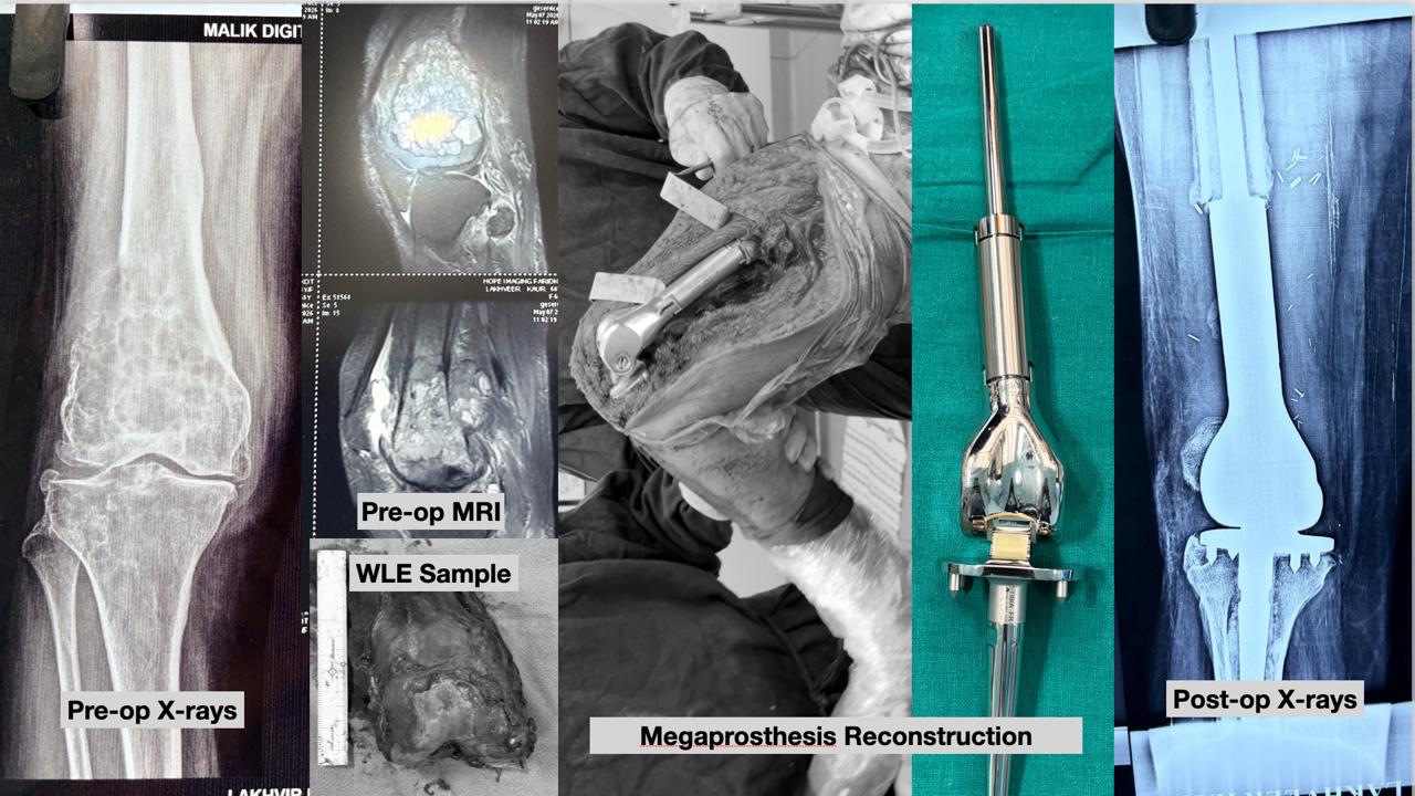 A RARE CASE OF MALIGNANT PRIMARY GCT OPERATED WITH LIMB SALVAGE SURGERY WITH WIDE LOCAL EXCISION + MEGAPROSTHESIS RECONSTRUCTION