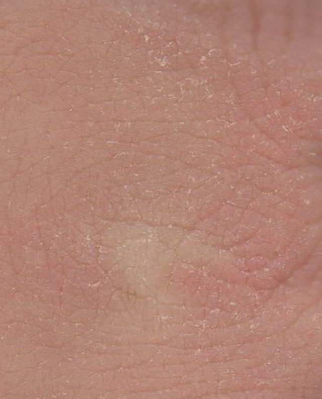 Symptom 12: Severe Dry, Itchy & Flaking Skin (Xerosis & Cutaneous Dehydration)