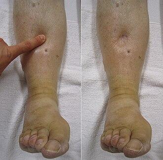 Sign 16: Pitting Edema: Deep Sock Indentations in Lower Legs