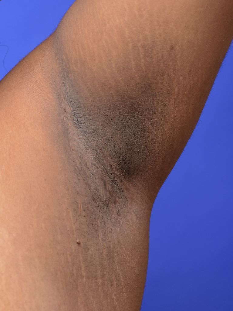 Symptom 6: Dark Velvety Skin Patches in Body Folds (Acanthosis Nigricans)