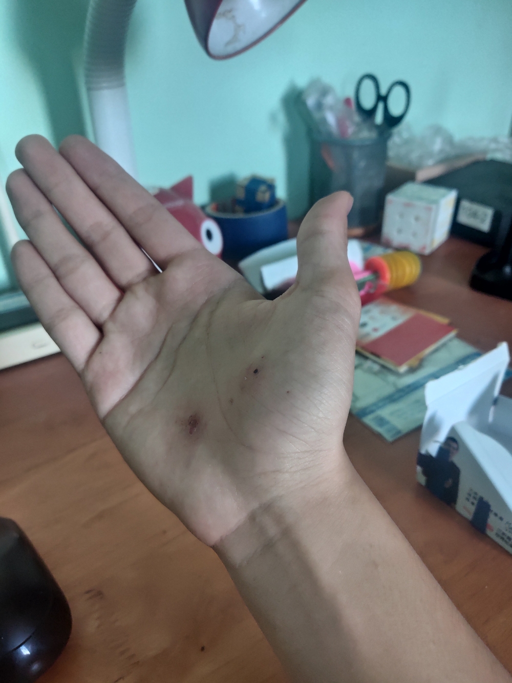 Left hand wound