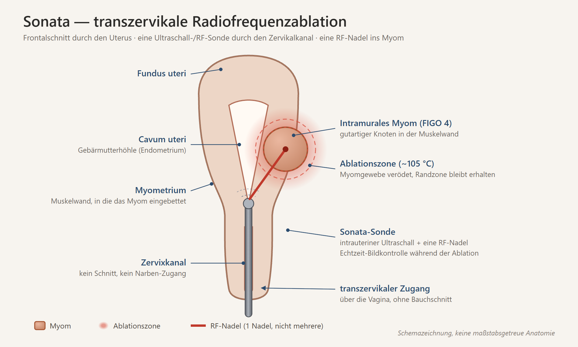 Schema: transzervikale Radiofrequenzablation — Uterus im Frontalschnitt, intramurales Myom FIGO 4, Sonde und RF-Nadel