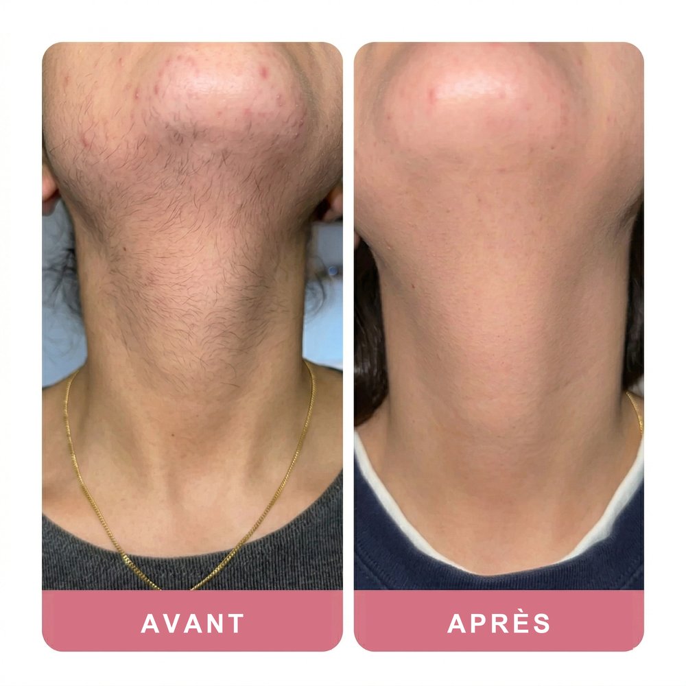 Avant / Après — Clara R.