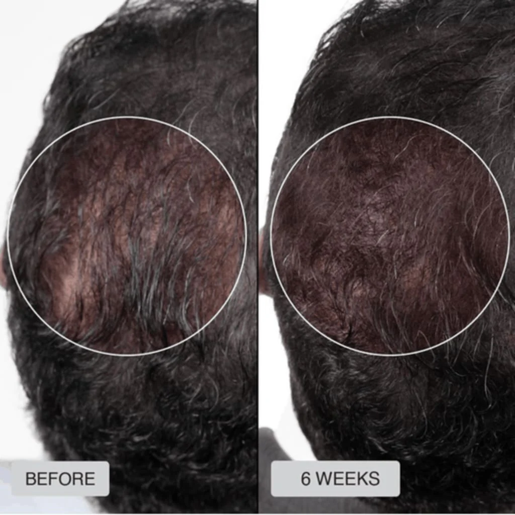 Before and 6 weeks crown comparison