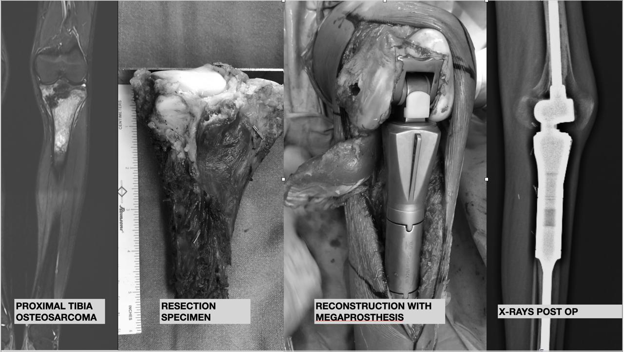 LIMB SALVAGE SURGERY WITH WIDE LOCAL EXCISION + RECONSTRUCTION WITH MEGAPROSTHESIS