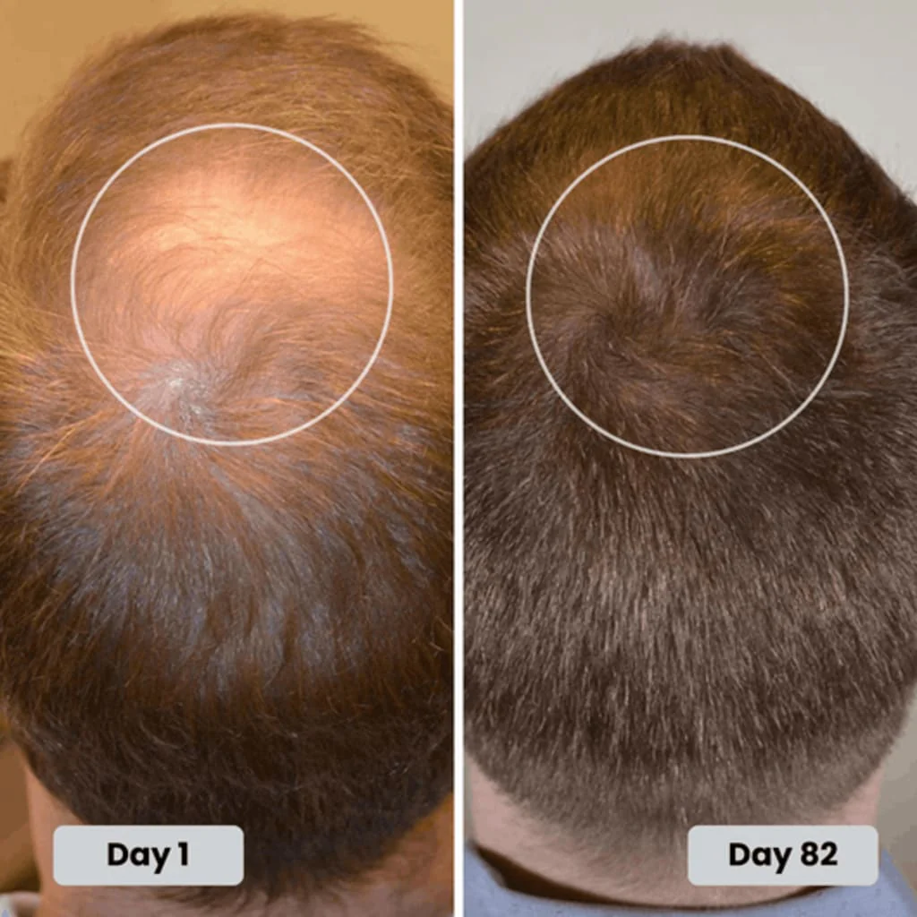 Crown regrowth, day 1 to day 82