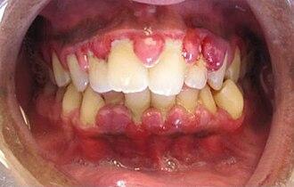 Sign 21: Bleeding, Spongy Gums (Arterial Inflammation)