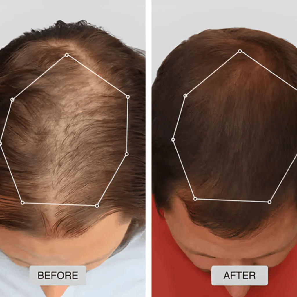 Before and after hairline